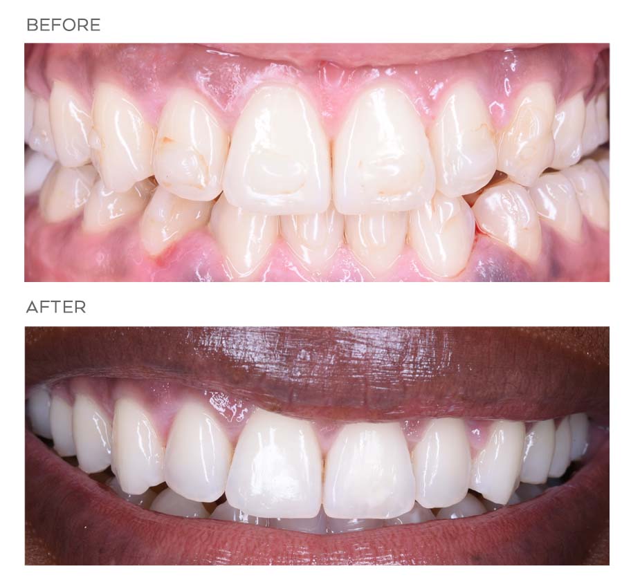 Before and after closeup. After is broader, whiter thanks to Invisalign in NYC.