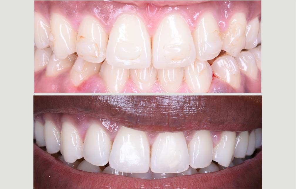 INVISALIGN case