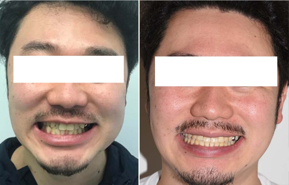 INVISALIGN_MSE