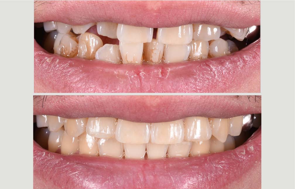 INVISALIGN_MSE