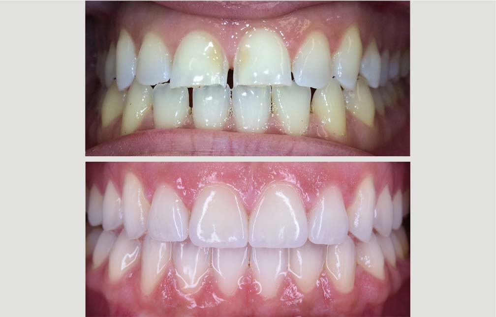 INVISALIGN_VENEERS_STEPHANIE_2